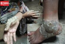 આશ્રમશાળાની બેદરકારીથી વીજ કરંટ લાગતા ધો. 9 ની આદિવાસી વિદ્યાર્થિની ગંભીર ઘાયલ: કેમ રહી સારવાર અધૂરી ?