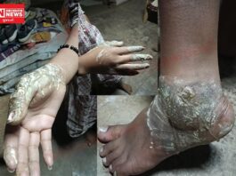 આશ્રમશાળાની બેદરકારીથી વીજ કરંટ લાગતા ધો. 9 ની આદિવાસી વિદ્યાર્થિની ગંભીર ઘાયલ: કેમ રહી સારવાર અધૂરી ?